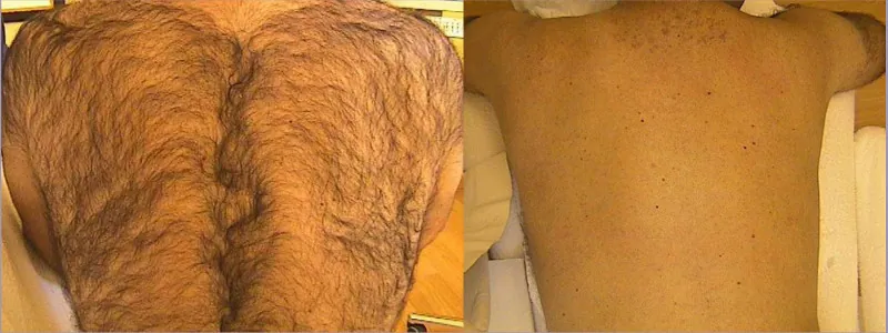Depilacja Laserowa - Epilacja Plecy